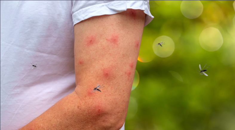 Person's arm covered in red mosquito bites with mosquitoes flying around.