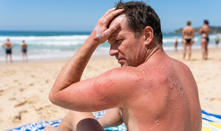 Man sitting on a beach with severe red, peeling sunburn.