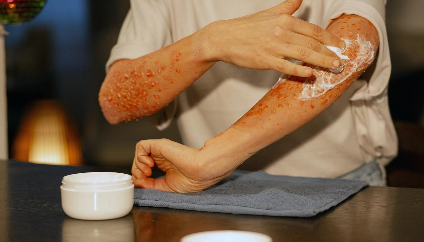 Person applying white soothing cream onto irritated, severe skin rash.